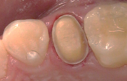 Tooth preparation for All-Ceramic Crowns
